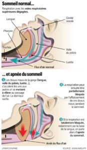Apnée du sommeil : comment s'en sortir