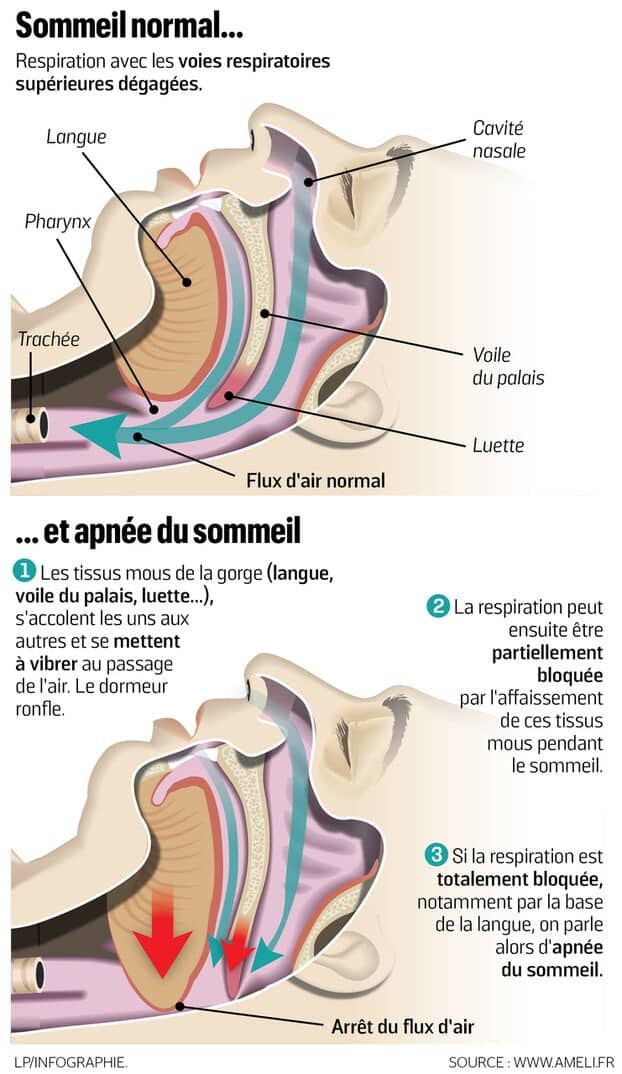 Apnée du sommeil comment s'en sortir — free download